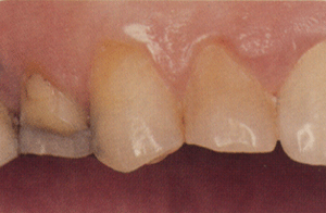 Zb przed leczeniem.